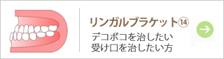 リンガルブラケット⑭