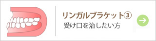 リンガルブラケット③