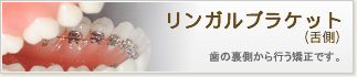 リンガルブラケット