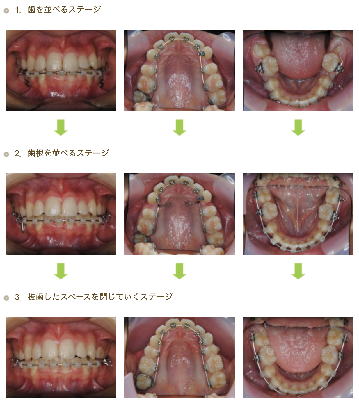 ハーフリンガル②　八重歯を治したい方