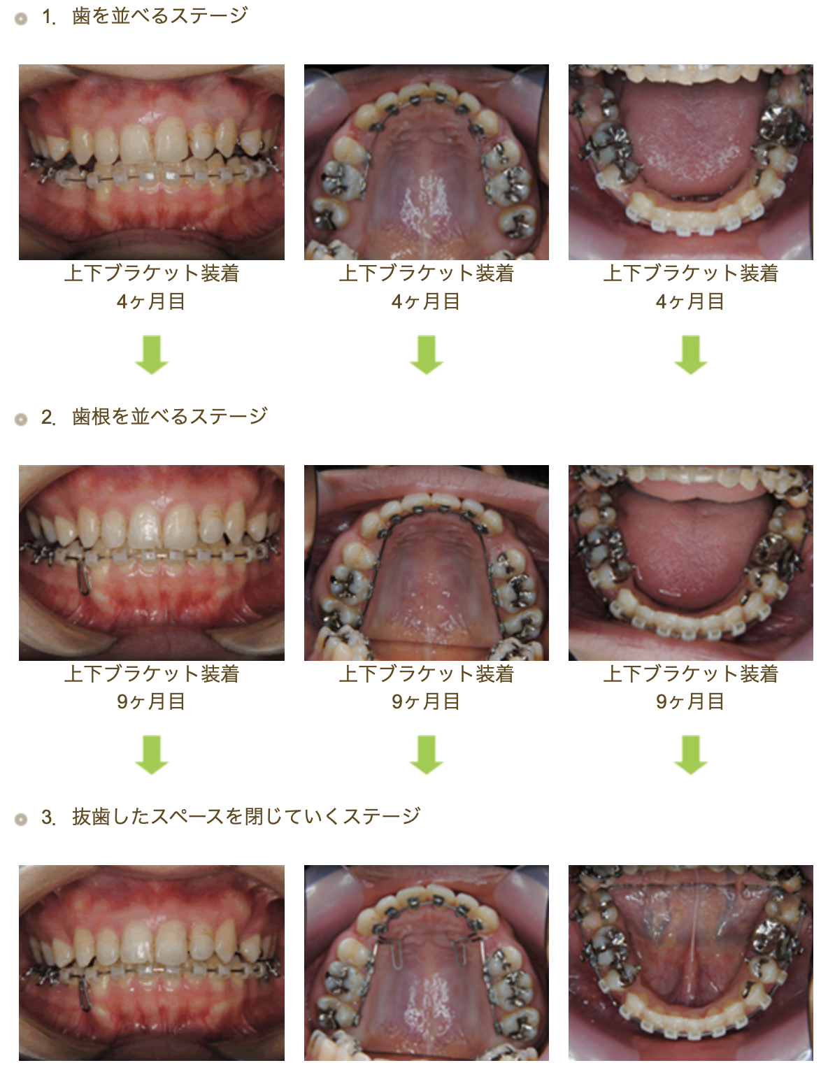 ハーフリンガル①　デコボコを治したい方