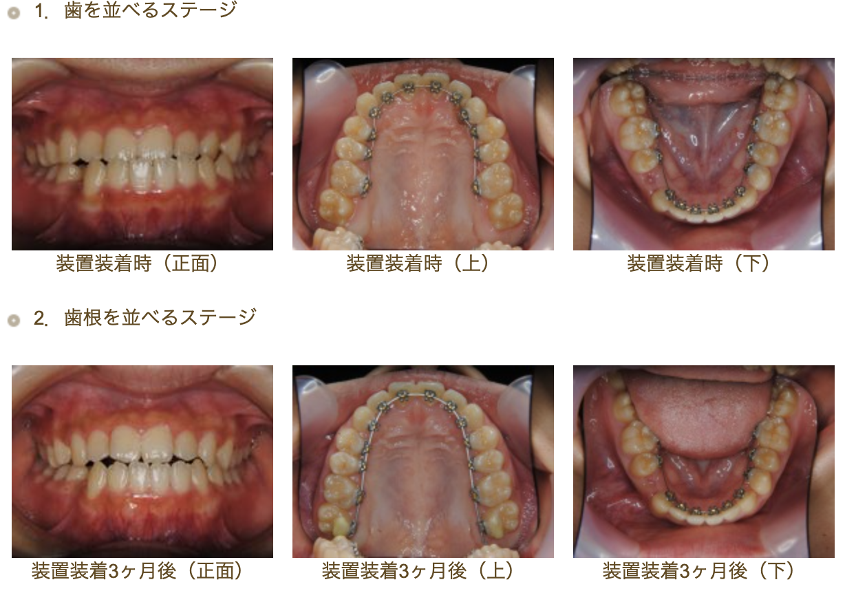 リンガルブラケット㉑　受け口を治したい方