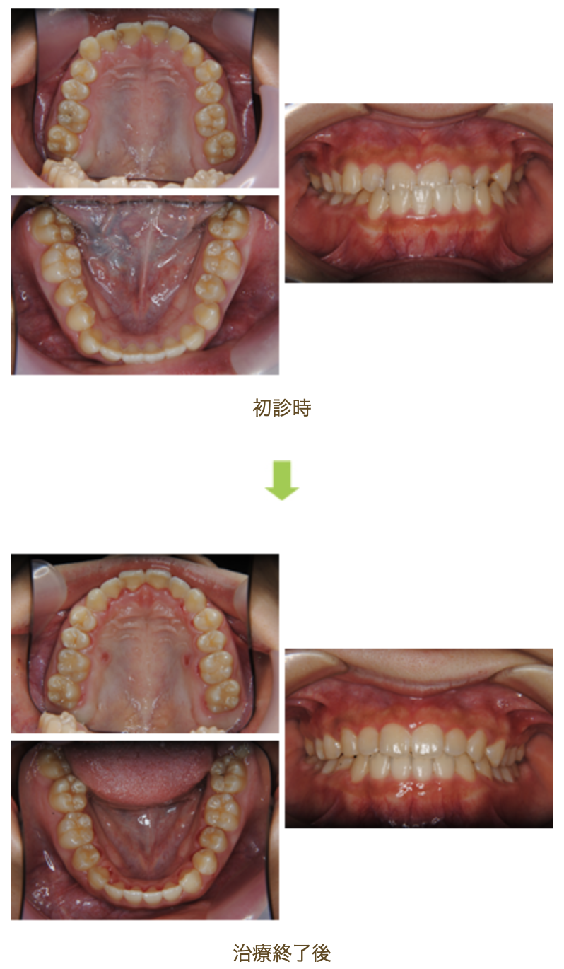リンガルブラケット㉑　受け口を治したい方