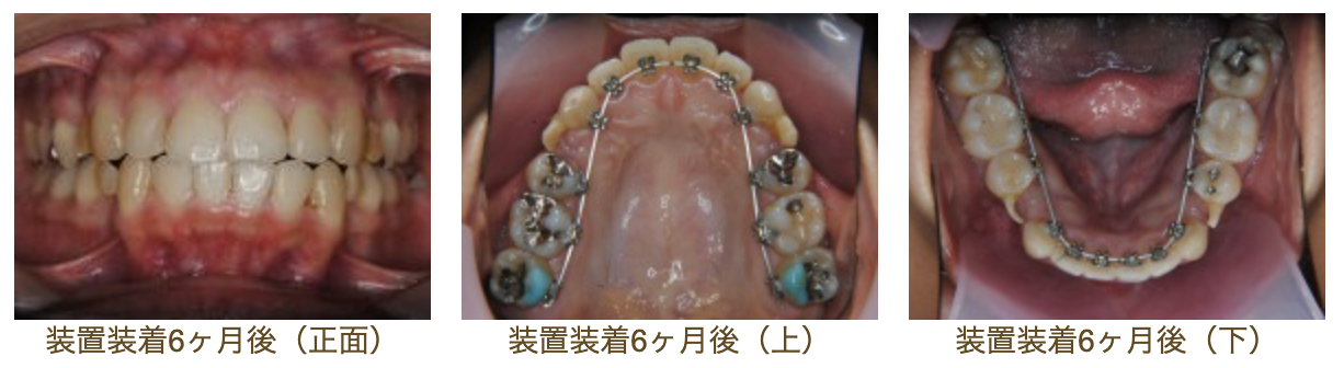 リンガルブラケット⑳　口元を引っ込めたい方