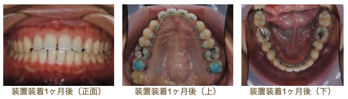 リンガルブラケット⑲　口元を引っ込めたい方