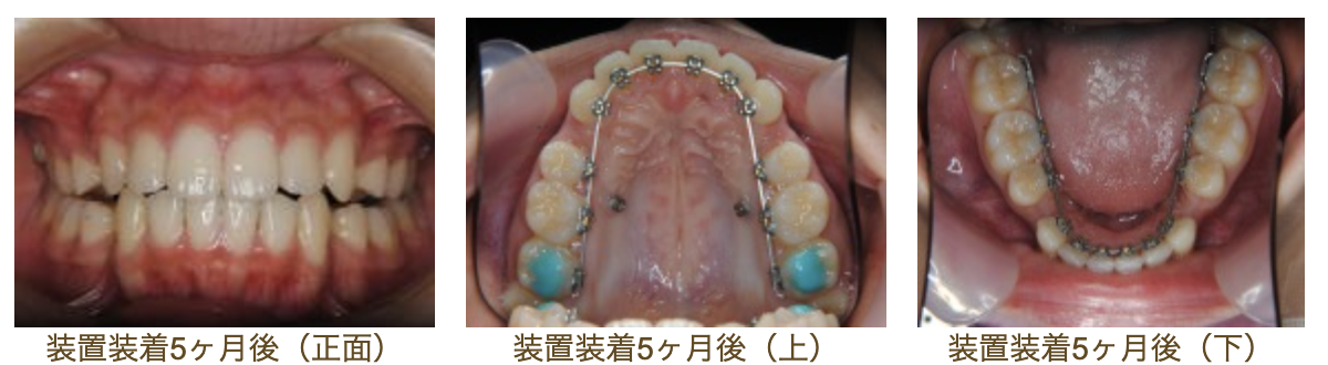 リンガルブラケット⑱　口元を引っ込めたい方