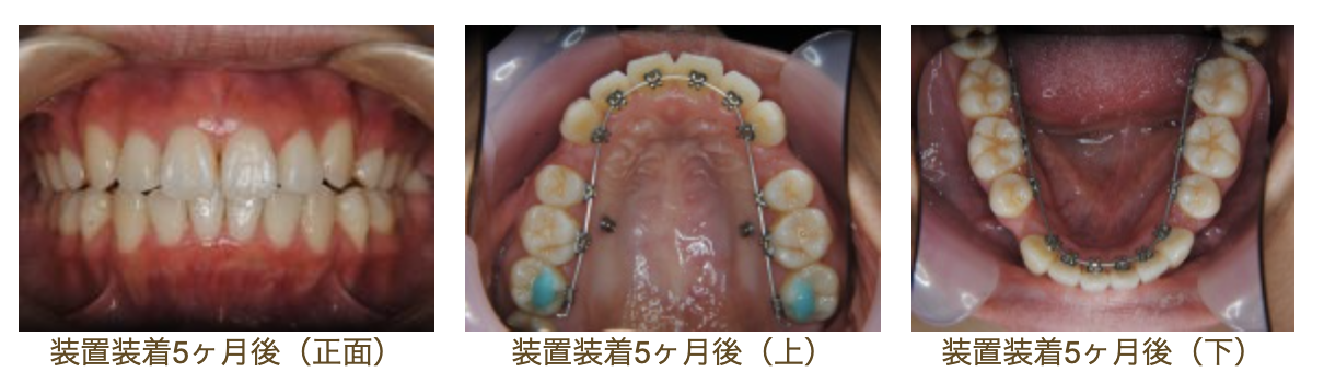リンガルブラケット⑰　口元を引っ込めたい方