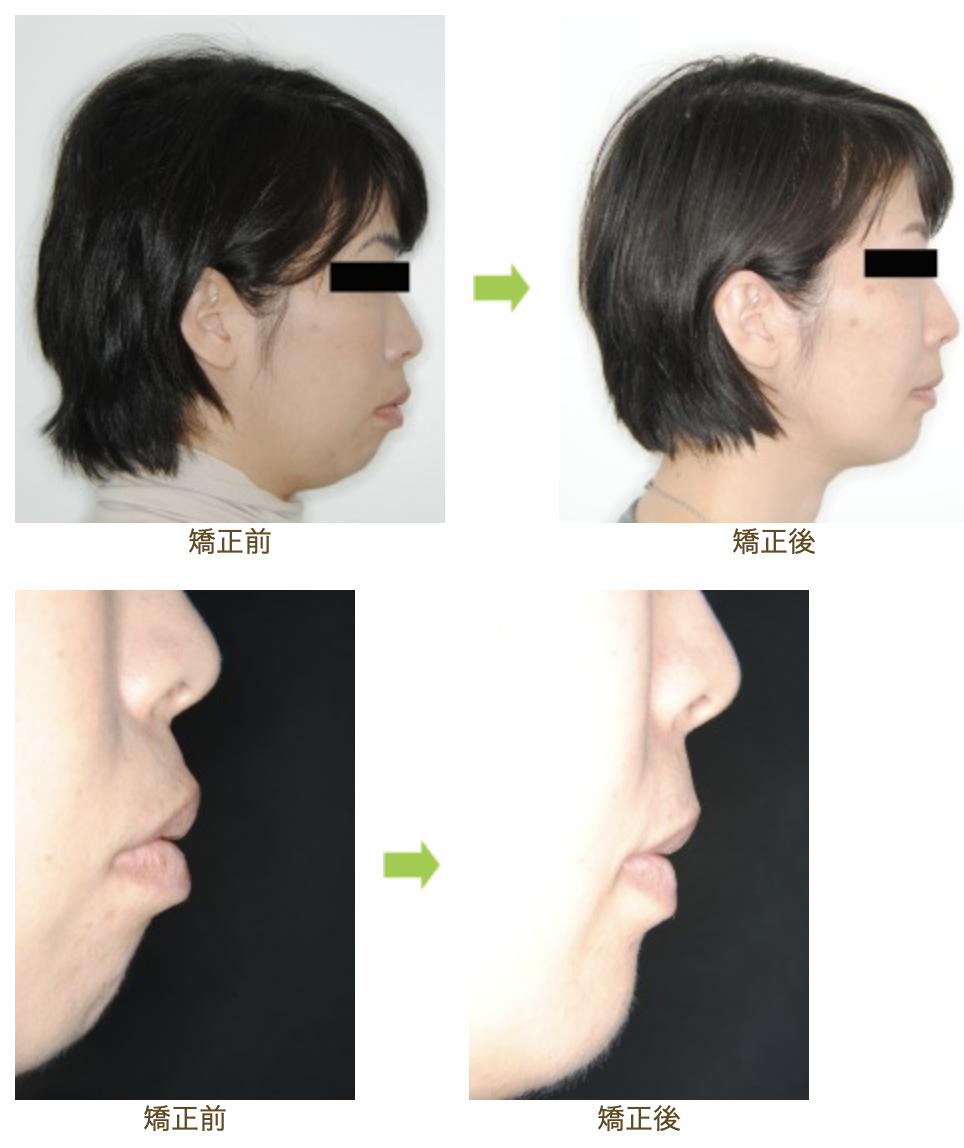 リンガルブラケット⑰　口元を引っ込めたい方