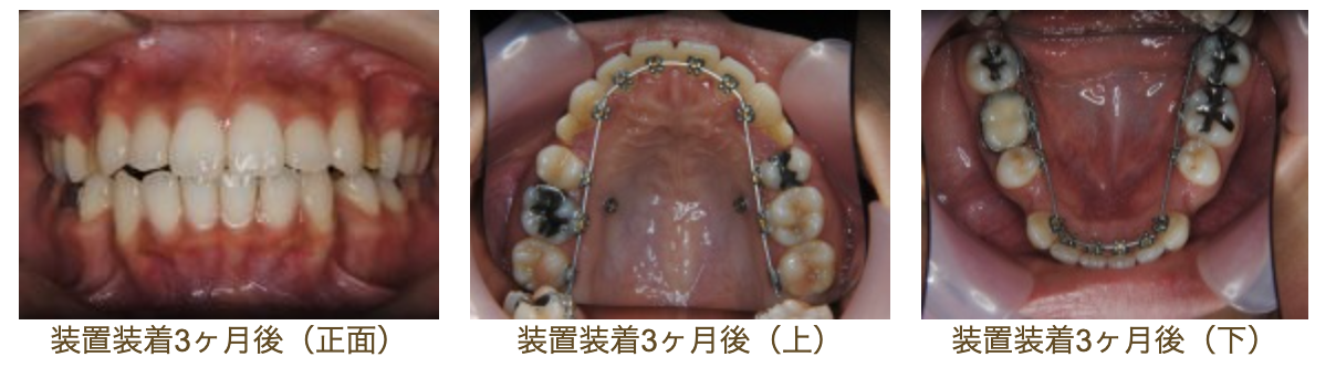 リンガルブラケット⑯　口元を引っ込めたい方