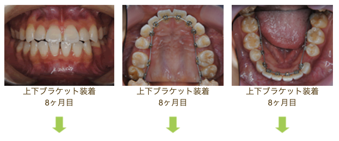 リンガルブラケット⑭　デコボコを治したい 受け口を治したい方
