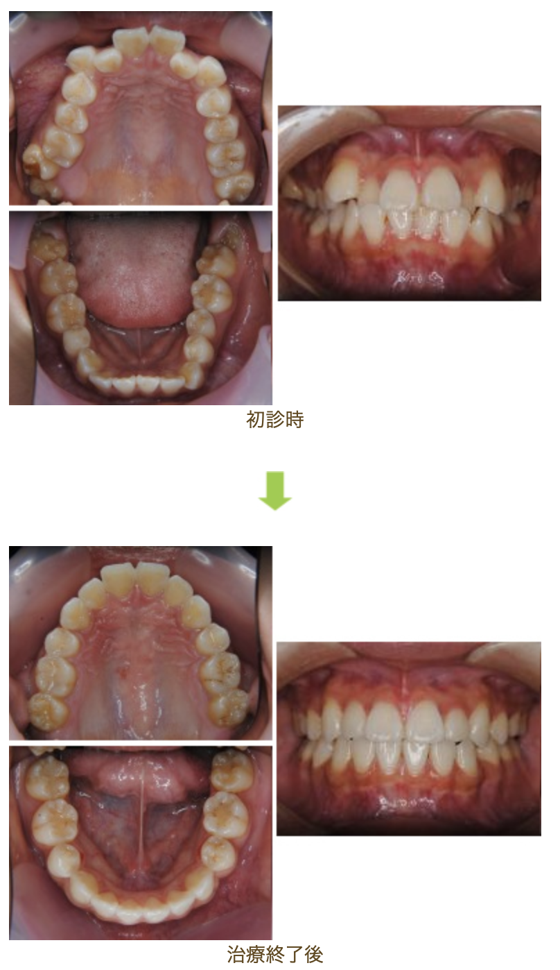 リンガルブラケット⑭　デコボコを治したい 受け口を治したい方