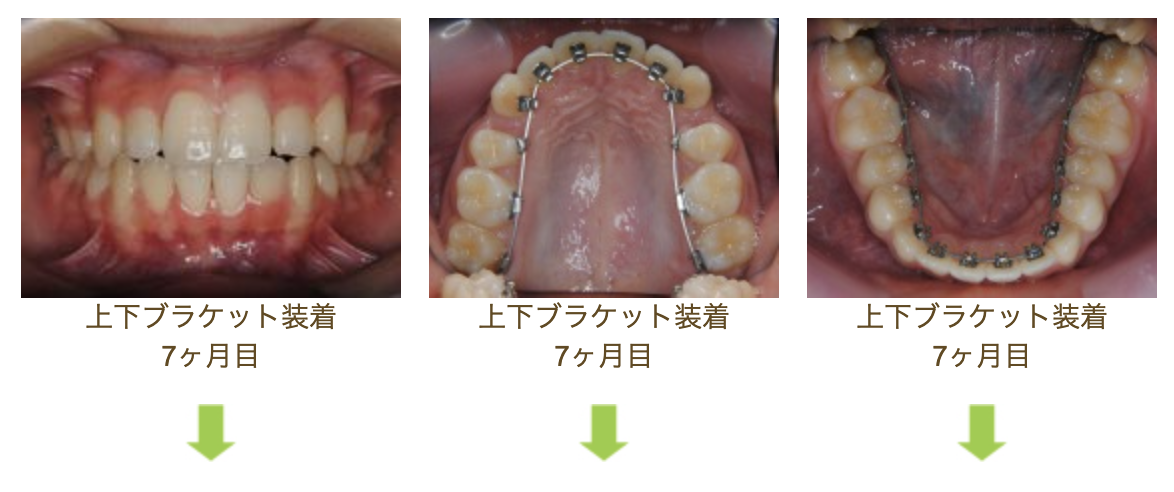 リンガルブラケット⑬　八重歯を治したい方