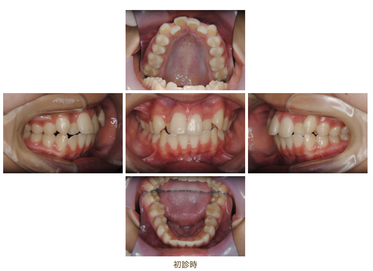 リンガルブラケット⑬　八重歯を治したい方
