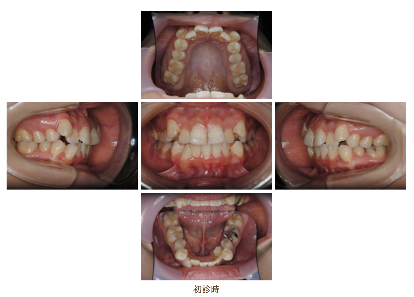 リンガルブラケット⑫　八重歯を治したい方
