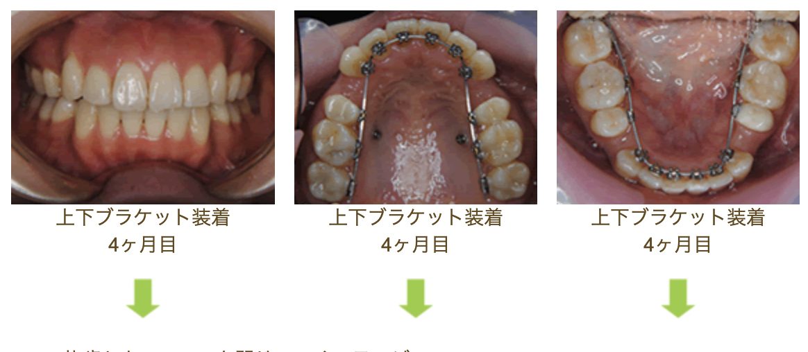 リンガルブラケット⑪　口元を引っ込めたい方