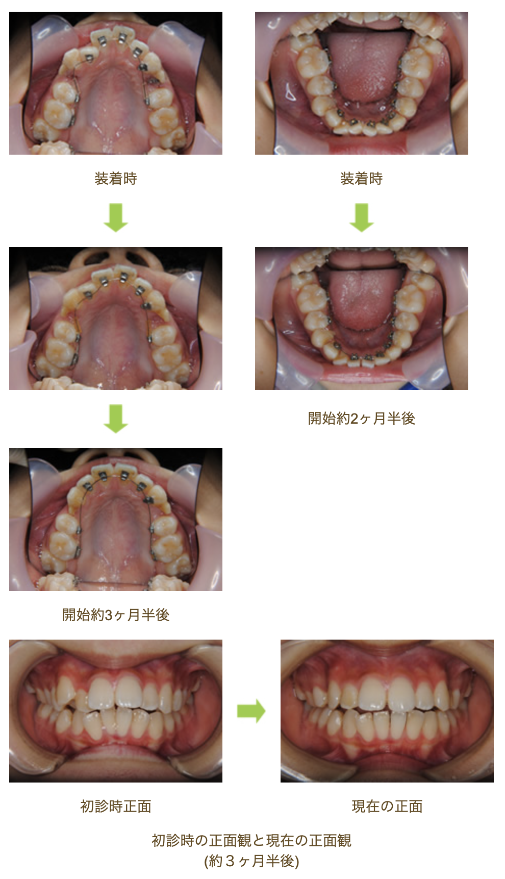 リンガルブラケット⑩　出っ歯を治したい方