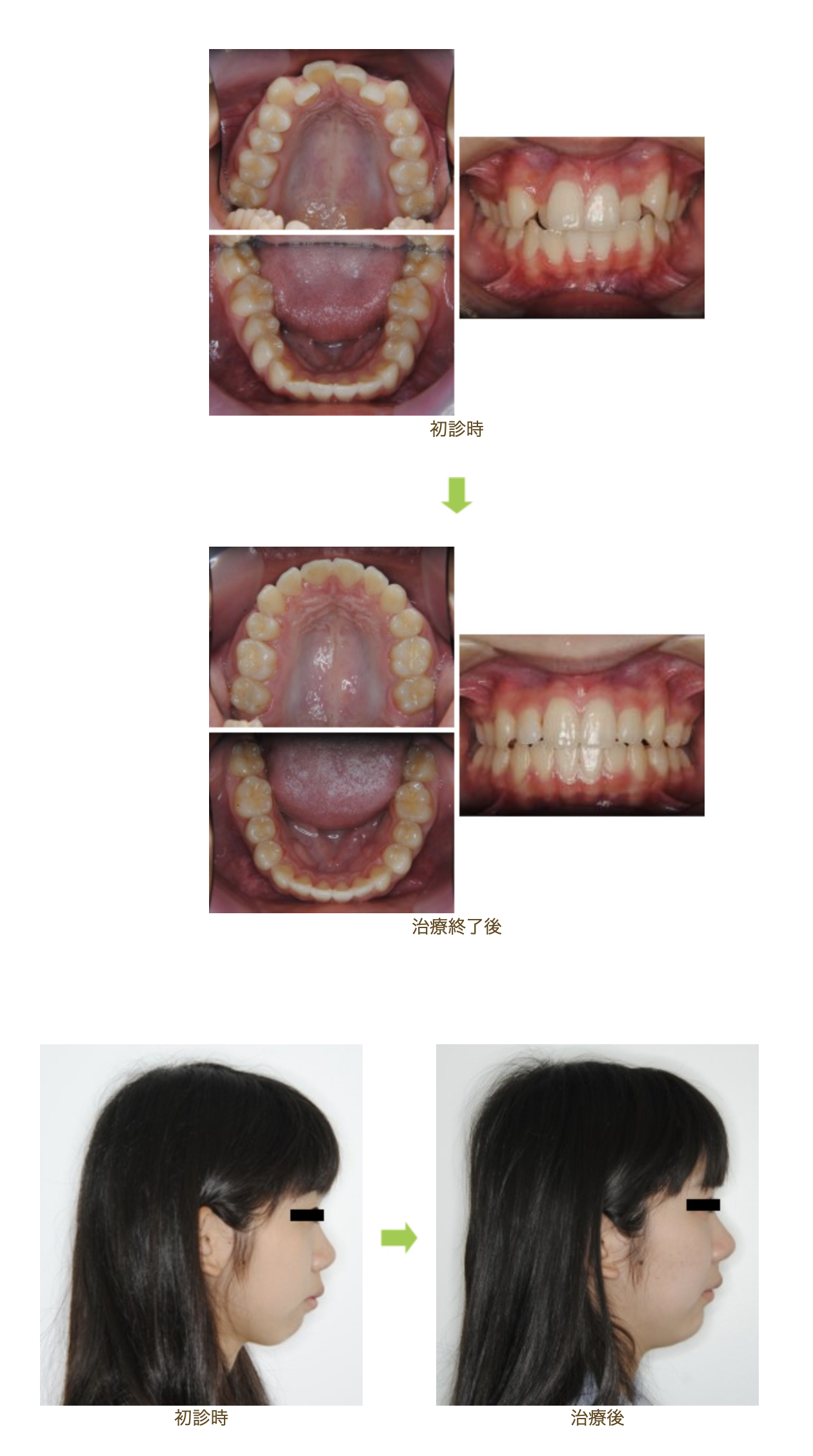 リンガルブラケット⑩　出っ歯を治したい方