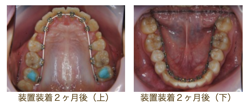 リンガルブラケット⑨　口元を引っ込めたい方
