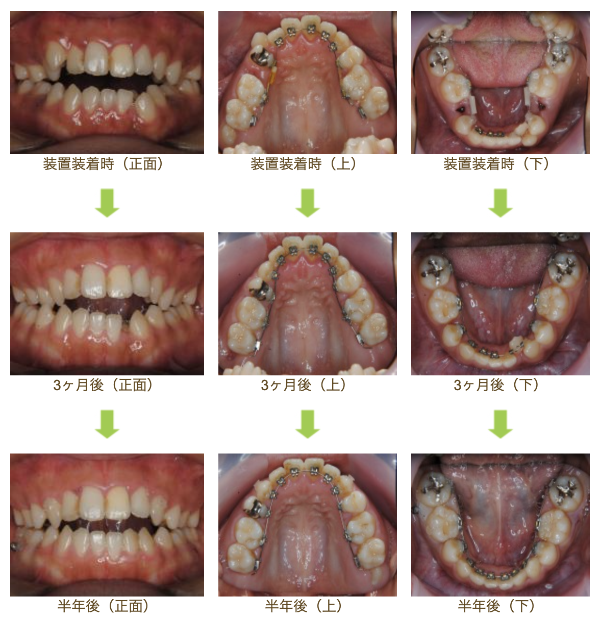 リンガルブラケット⑧　前歯の噛み合わせを治したい方