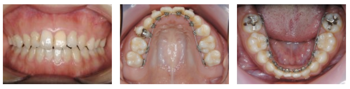 リンガルブラケット⑧　前歯の噛み合わせを治したい方