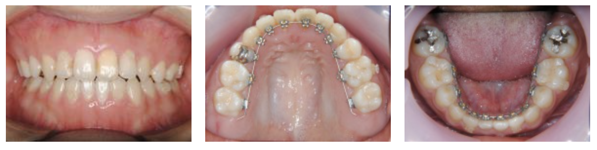 リンガルブラケット⑧　前歯の噛み合わせを治したい方