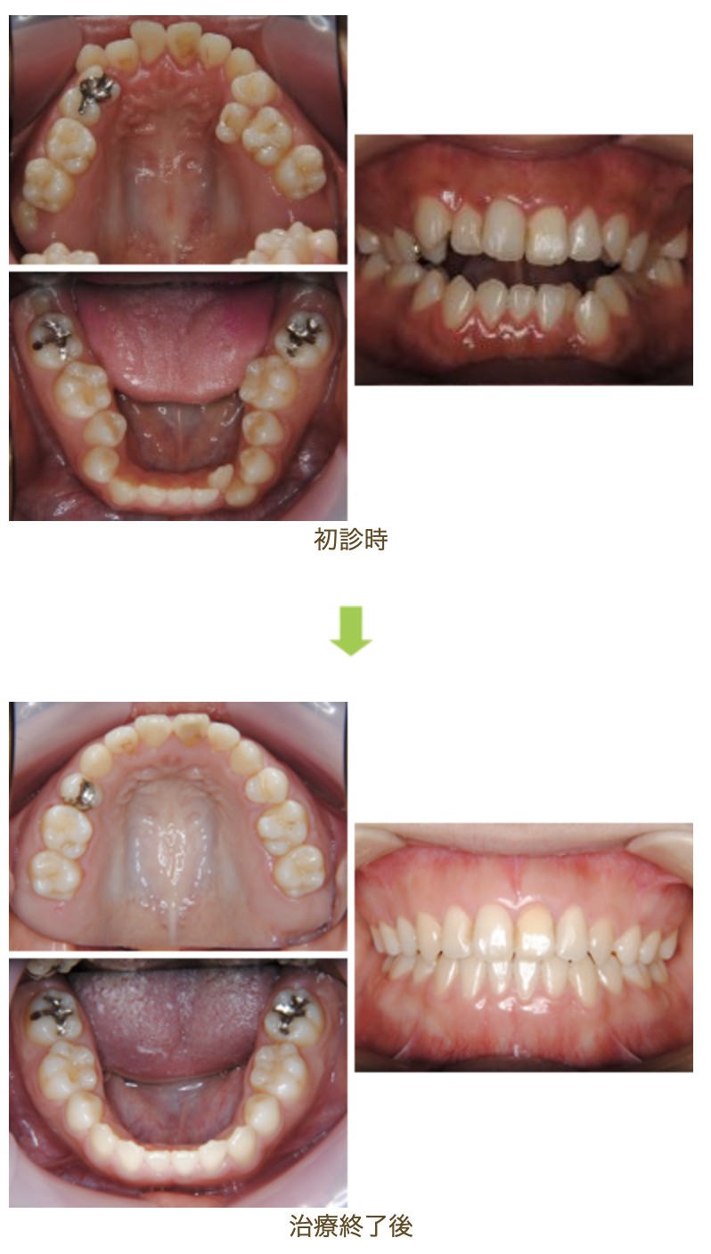 リンガルブラケット⑧　前歯の噛み合わせを治したい方
