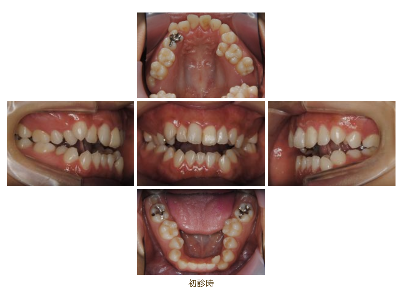 リンガルブラケット⑧　前歯の噛み合わせを治したい方