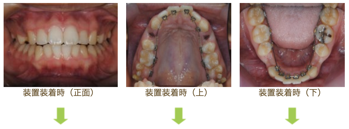 リンガルブラケット⑦　口元を引っ込めたい方