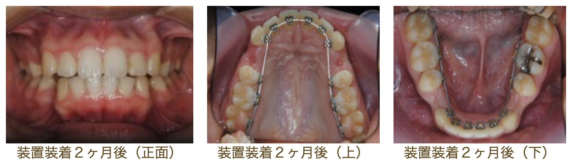 リンガルブラケット⑦　口元を引っ込めたい方