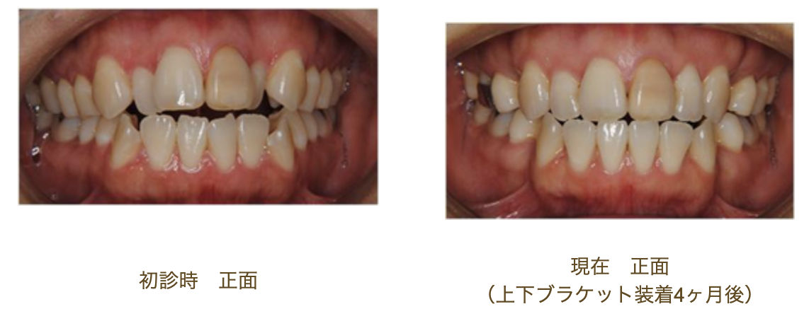 リンガルブラケット⑥　口元を引っ込めたい 前歯の噛み合わせを治したい方