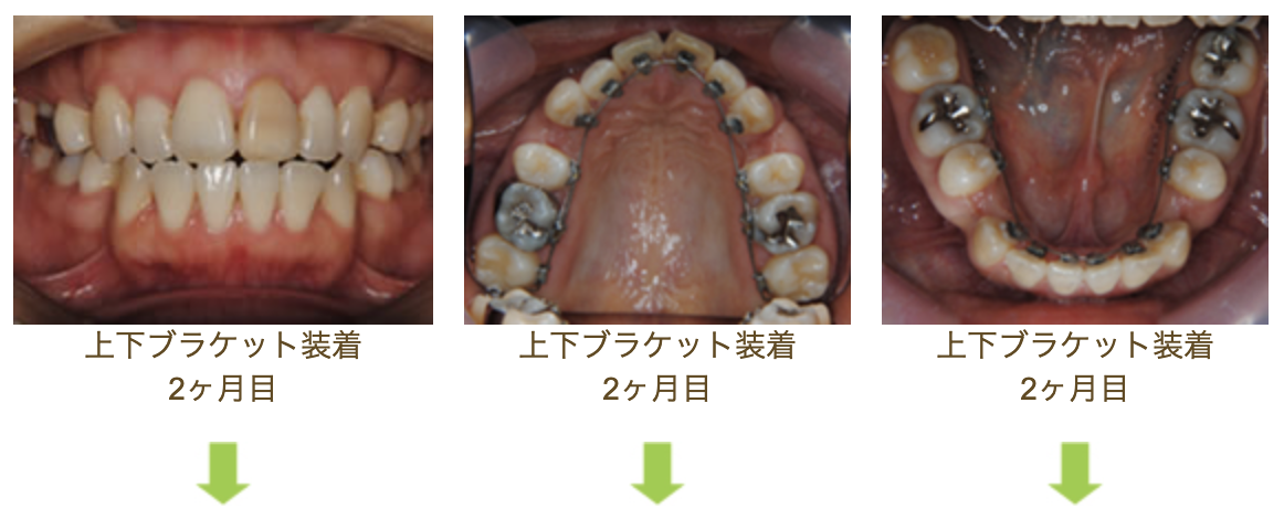 リンガルブラケット⑥　口元を引っ込めたい 前歯の噛み合わせを治したい方