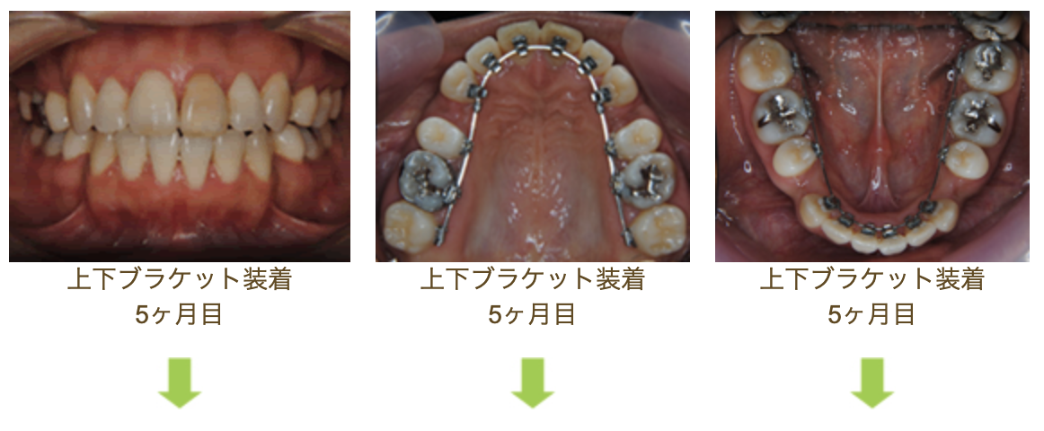 リンガルブラケット⑥　口元を引っ込めたい 前歯の噛み合わせを治したい方