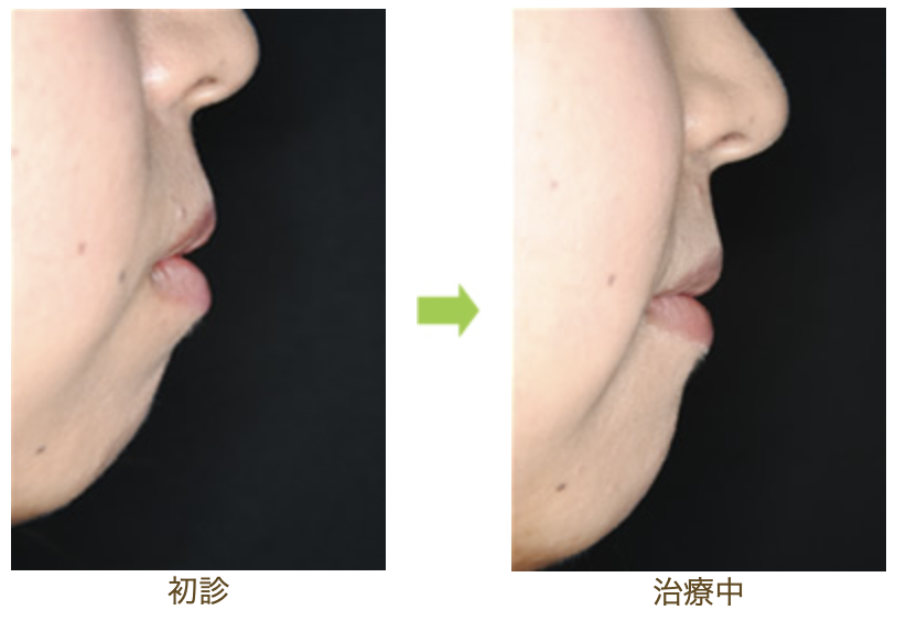 リンガルブラケット⑥　口元を引っ込めたい 前歯の噛み合わせを治したい方