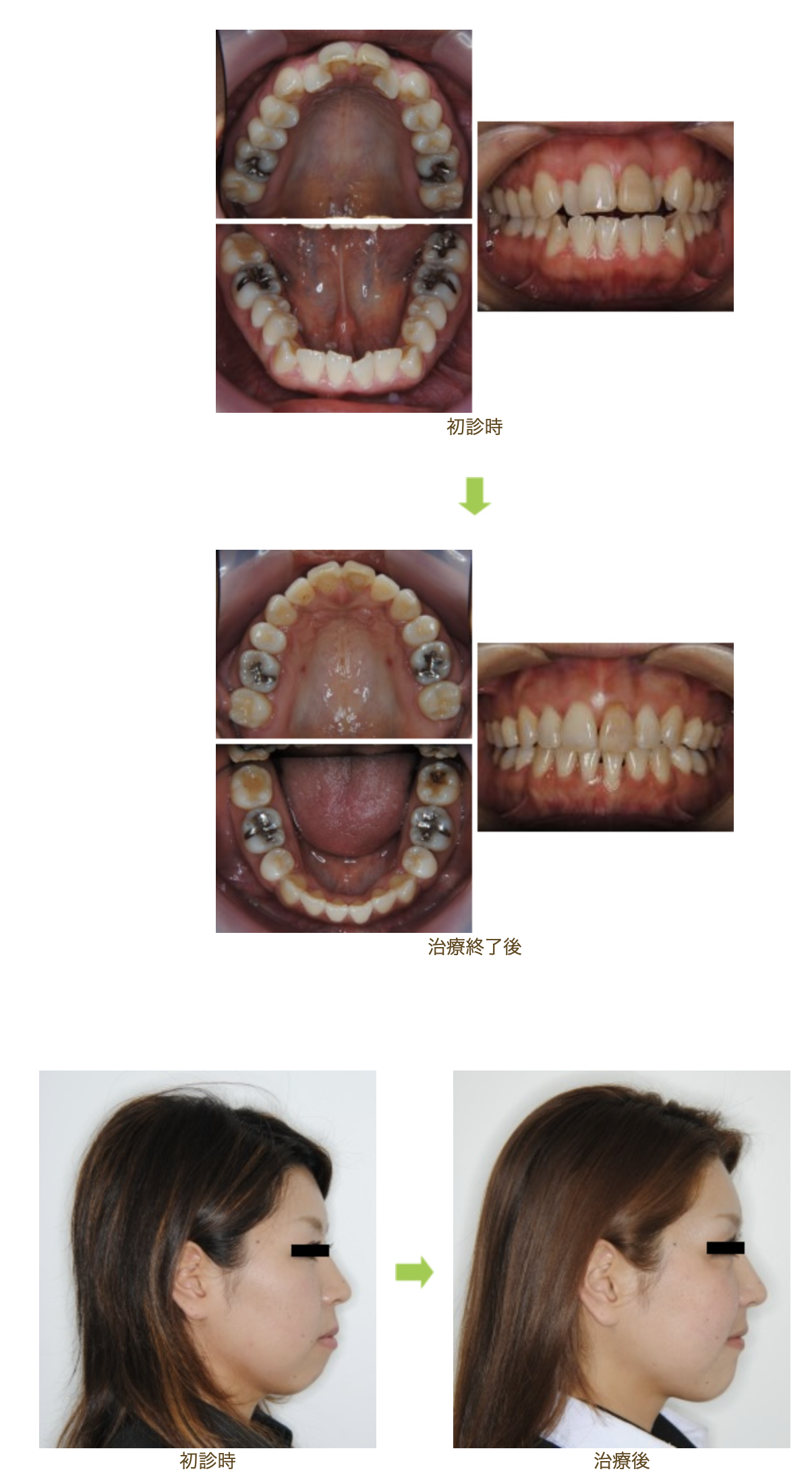 リンガルブラケット⑥　口元を引っ込めたい 前歯の噛み合わせを治したい方