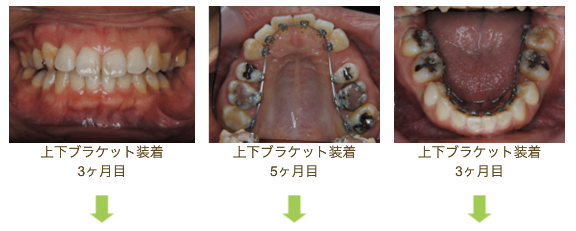 リンガルブラケット④　デコボコを治したい方