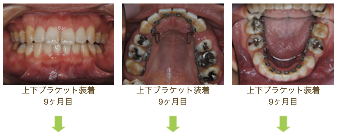 リンガルブラケット④　デコボコを治したい方