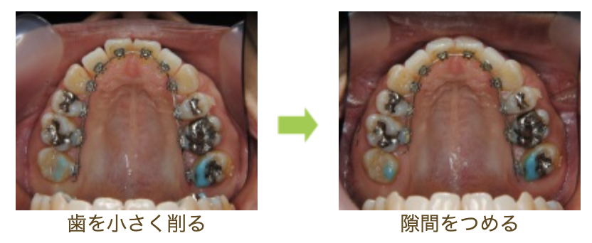 リンガルブラケット④　デコボコを治したい方