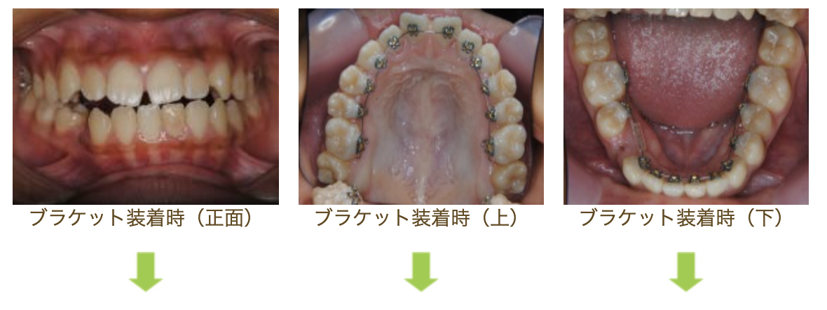 リンガルブラケット③　受け口を治したい方