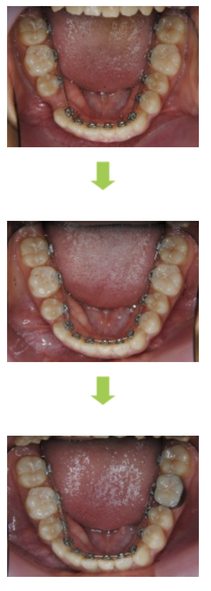リンガルブラケット③　受け口を治したい方