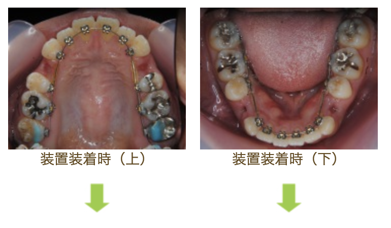 リンガルブラケット②　口元を引っ込めたい方