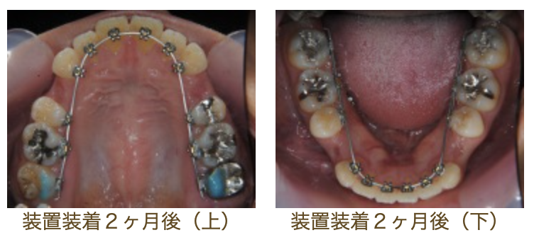 リンガルブラケット②　口元を引っ込めたい方