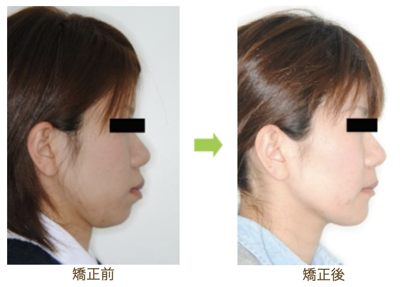 リンガルブラケット②　口元を引っ込めたい方