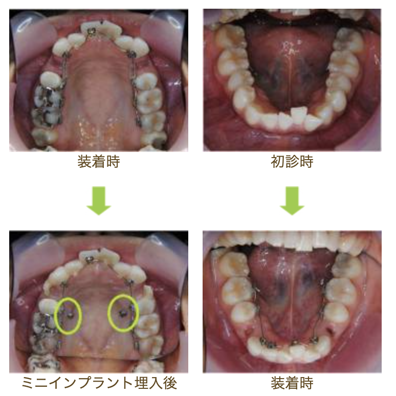 リンガルブラケット①　口元を引っ込めたい方