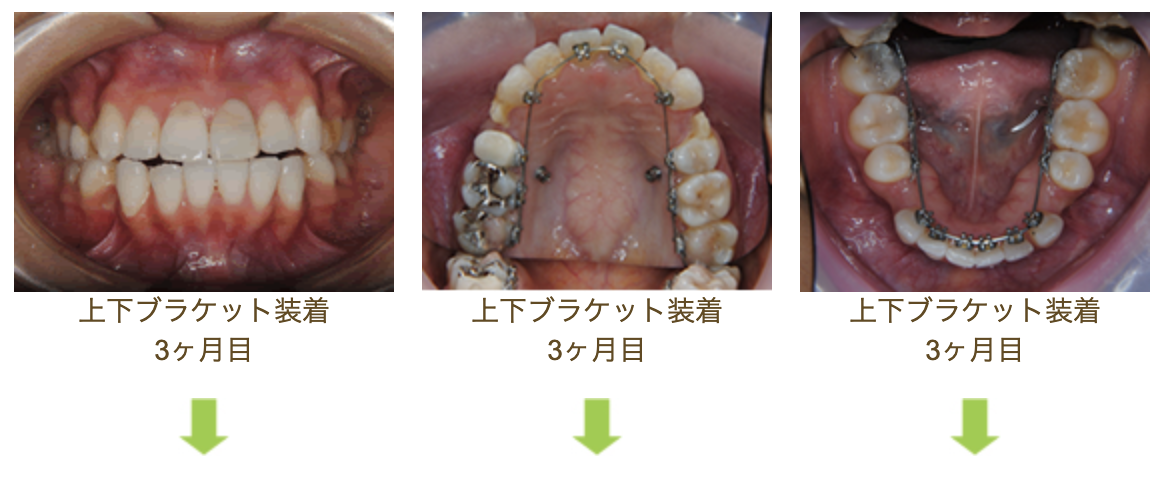 リンガルブラケット①　口元を引っ込めたい方