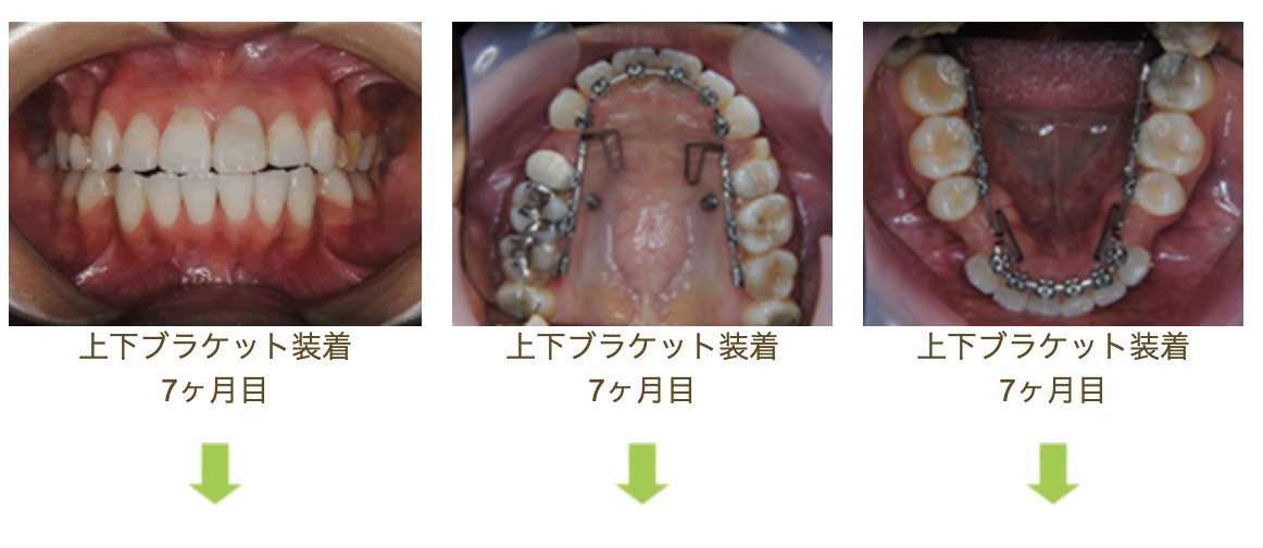 リンガルブラケット①　口元を引っ込めたい方