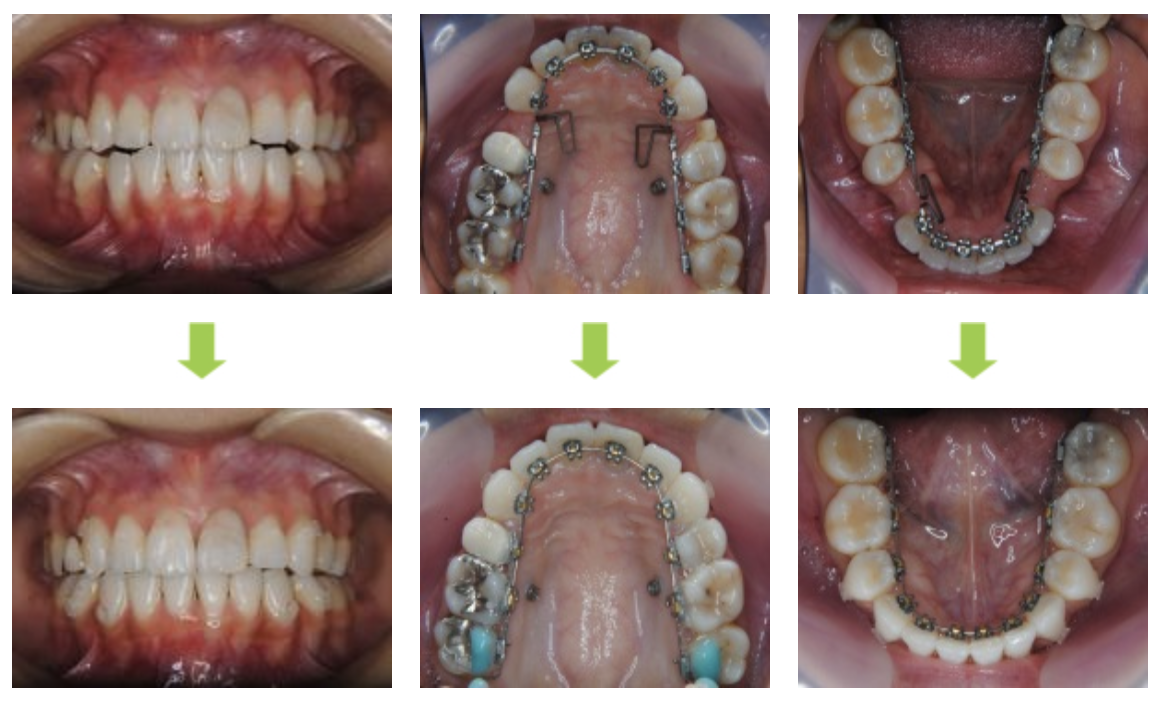 リンガルブラケット①　口元を引っ込めたい方