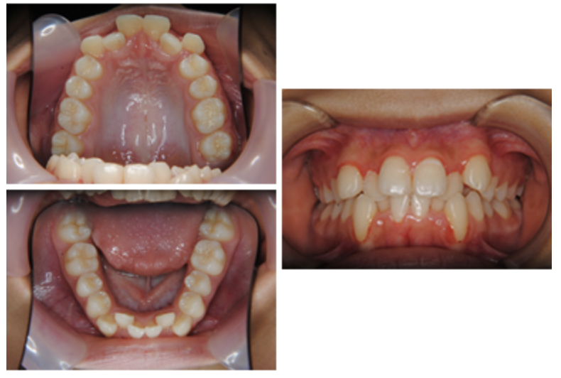 マウスピース型矯正装置（インビザライン）⑤　デコボコを治したい方