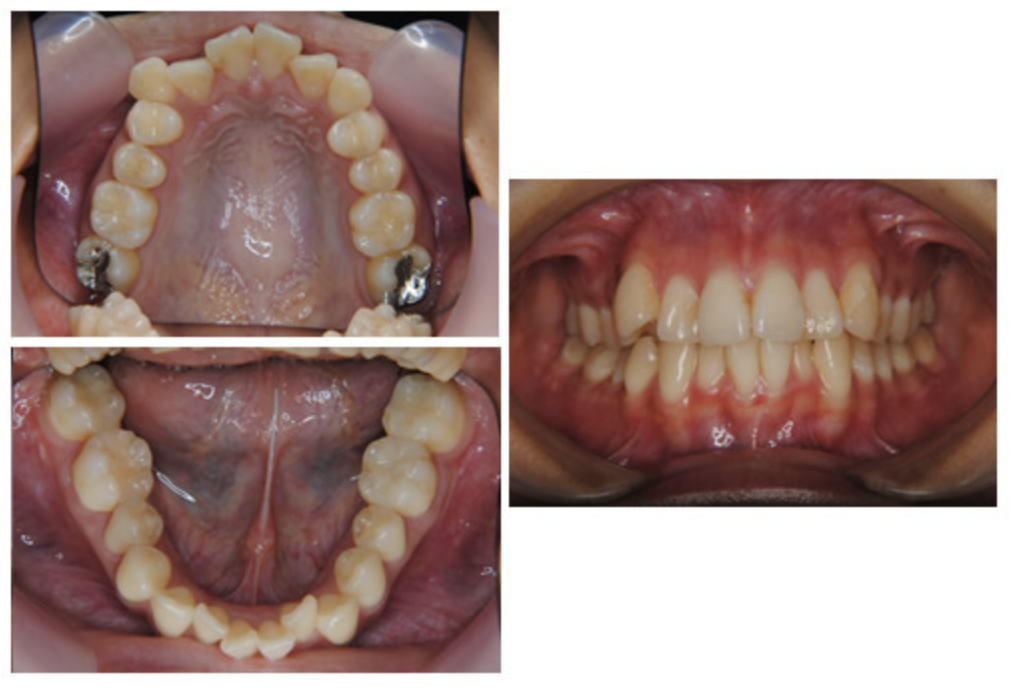 マウスピース型矯正装置（インビザライン）④　デコボコを治したい方