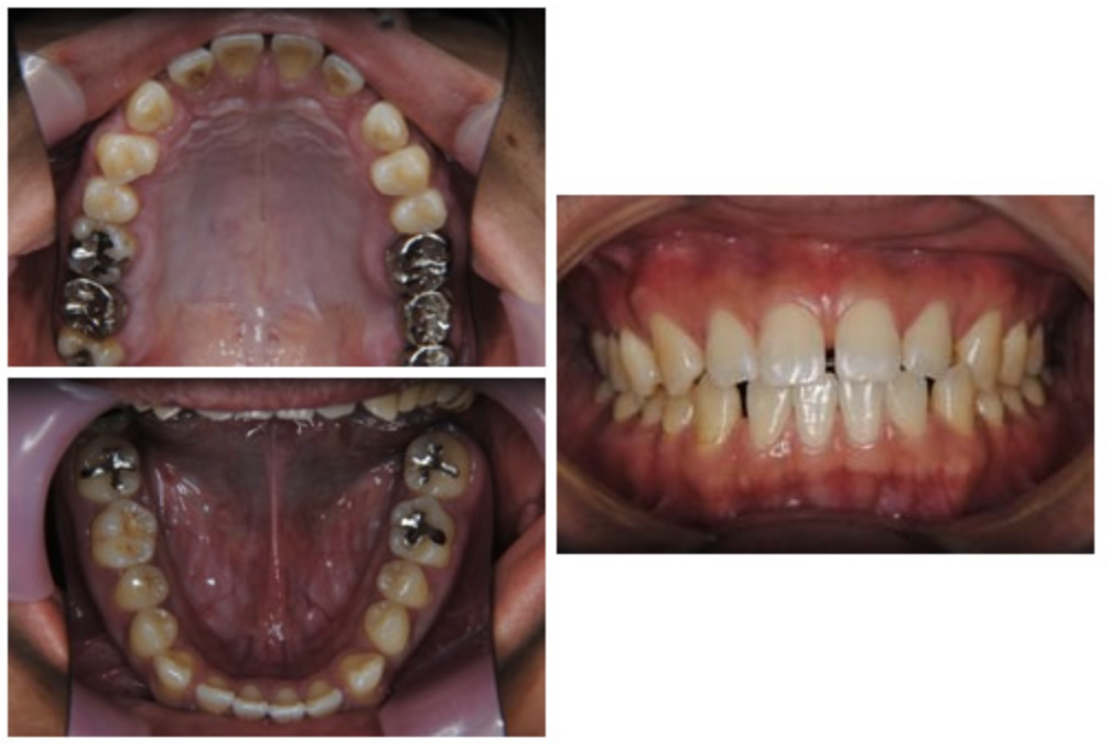 マウスピース型矯正装置（インビザライン）③　すきっ歯を治したい方